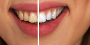 Teeth Whitening in Turkey