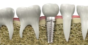 Dental Implants