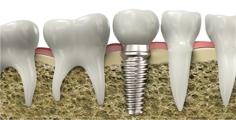 Dental Implants Unveiled: A Masterpiece of Confidence and Functionality