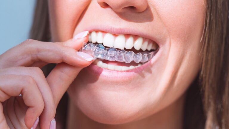 London’s Smile Secret: Clear Aligners for a Radiant Grin